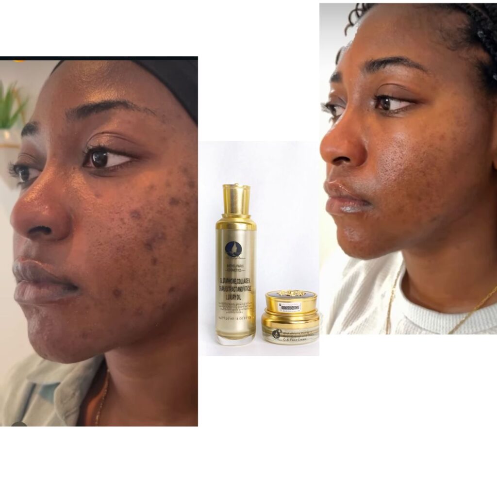 Hormonal acne, fading gradually